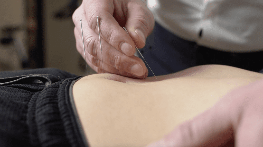 Acupunctuur bij IMC Babborga in Zevenaar.
